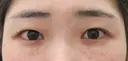 埋没4点留め+目頭切開術+クマ治療(下眼瞼脱脂術) before画像 サムネイル用
