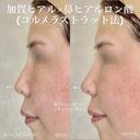 加賀ヒアル×コルメラストラット法 before画像 サムネイル用