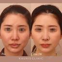 鼻中隔延長 after画像 サムネイル用