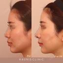 鼻中隔延長 after画像 サムネイル用