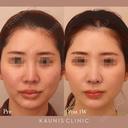 鼻中隔延長 after画像 サムネイル用