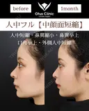 人中フル【人中短縮・鼻翼縮小・鼻翼挙上・口角挙上・外側人中短縮】 before画像 サムネイル用