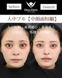 人中フル【人中短縮・鼻翼縮小・鼻翼挙上・口角挙上・外側人中短縮】 30日後 サムネイル用