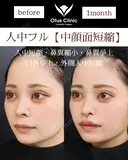 人中フル【人中短縮・鼻翼縮小・鼻翼挙上・口角挙上・外側人中短縮】 30日後 サムネイル用