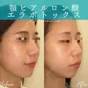 ヒアルロン酸(あご)＋ボトックス(エラ) 14日後 サムネイル用