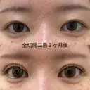 二重全切開 90日後 サムネイル用
