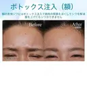 【30代女性・眉間のしわを改善】眉間ボトックス（1週間後） before画像 サムネイル用