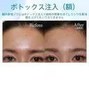 【30代女性・眉間のしわを改善】眉間ボトックス（1週間後） after画像 サムネイル用