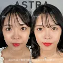 鼻尖形成・軟骨移植・小鼻縮小・鼻他院修正 before画像 サムネイル用