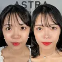 鼻尖形成・軟骨移植・小鼻縮小・鼻他院修正 after画像 サムネイル用