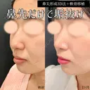 鼻尖形成3D法、軟骨移植、MD式 30日後 サムネイル用