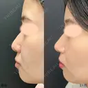 鼻尖形成3D法、軟骨移植、MD式 30日後 サムネイル用