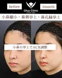 小鼻縮小・鼻翼挙上・鼻孔縁挙上 before画像 サムネイル用