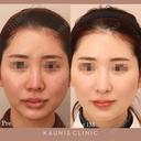 鼻中隔延長 after画像 サムネイル用