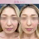 貴族フィラー before画像 サムネイル用