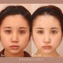 鼻中隔延長、他院鼻プロテーゼ加工、他院修正 after画像 サムネイル用