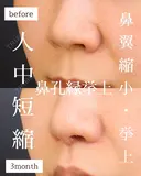 人中短縮・小鼻縮小・鼻翼挙上・鼻孔縁挙上 90日後 サムネイル用
