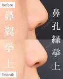 人中短縮・小鼻縮小・鼻翼挙上・鼻孔縁挙上 90日後 サムネイル用