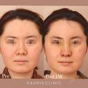 鼻中隔延長、鼻翼縮小(内側) before画像 サムネイル用