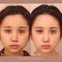 鼻中隔延長、他院鼻プロテーゼ加工、他院修正 after画像 サムネイル用
