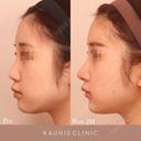 鼻中隔延長、他院鼻プロテーゼ加工、他院修正 after画像 サムネイル用