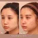 鼻中隔延長、他院鼻プロテーゼ加工、他院修正 after画像 サムネイル用