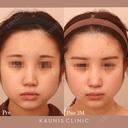 鼻中隔延長、他院鼻プロテーゼ加工、他院修正 after画像 サムネイル用