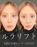 ルラリフト6部位 before画像 サムネイル用