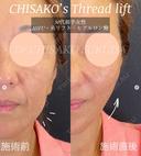 糸リフトとヒアルロン酸で直後からこんなに綺麗！ after画像 サムネイル用