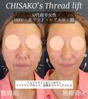アンチエイジングならお任せください。40代。糸リフトとヒアルロン酸で直後からこんなに綺麗！口元横もすっきり。 before画像 サムネイル用