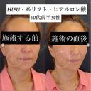 アンチエイジングならお任せください。40代。糸リフトとヒアルロン酸で直後からこんなに綺麗！口元横もすっきり。 after画像 サムネイル用