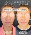 アンチエイジングならお任せください。40代。糸リフトとヒアルロン酸で1週間後。口元横すっきり美しい。 7日後 サムネイル用