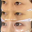 目の下のふくらみ取り after画像 サムネイル用