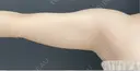 二の腕脂肪吸引 before画像 サムネイル用