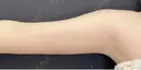 二の腕脂肪吸引 after画像 サムネイル用