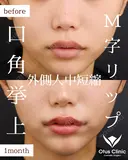 口角挙上・M字リップ・外側人中短縮 before画像 サムネイル用