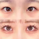 MD式たるみ取り併用全切開＋MD式目頭切開＋MD式切らないクマ取り before画像 サムネイル用