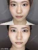 エラのボトックス after画像 サムネイル用