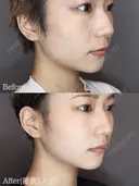 エラのボトックス before画像 サムネイル用