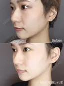エラのボトックス after画像 サムネイル用