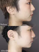 エラのボトックス after画像 サムネイル用