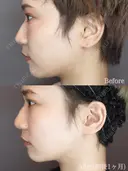 エラのボトックス after画像 サムネイル用