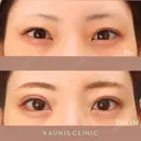 下眼瞼拡大、目尻切開、右埋没4点固定 after画像 サムネイル用