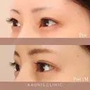 下眼瞼拡大、目尻切開、右埋没4点固定 after画像 サムネイル用