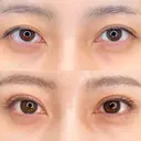二重埋没(クイックシンデレラ・ダブル) before画像 サムネイル用