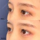 ヒアルロン酸(涙袋) before画像 サムネイル用