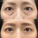 裏ハムラ法＋脂肪注入 before画像 サムネイル用