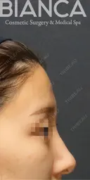 脂肪注入でSライン形成 before画像 サムネイル用