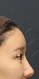 脂肪注入でSライン形成 after画像 サムネイル用