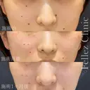 当院人気No1🌟ホクロ３個18,000円 after画像 サムネイル用
